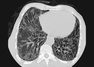 Interstitial Lung Diseases