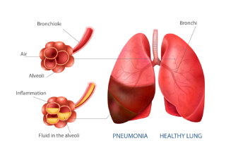 Pneumonia Treatments
