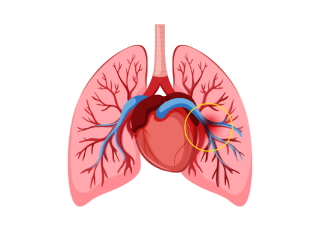 Pulmonary Embolism Treatment
